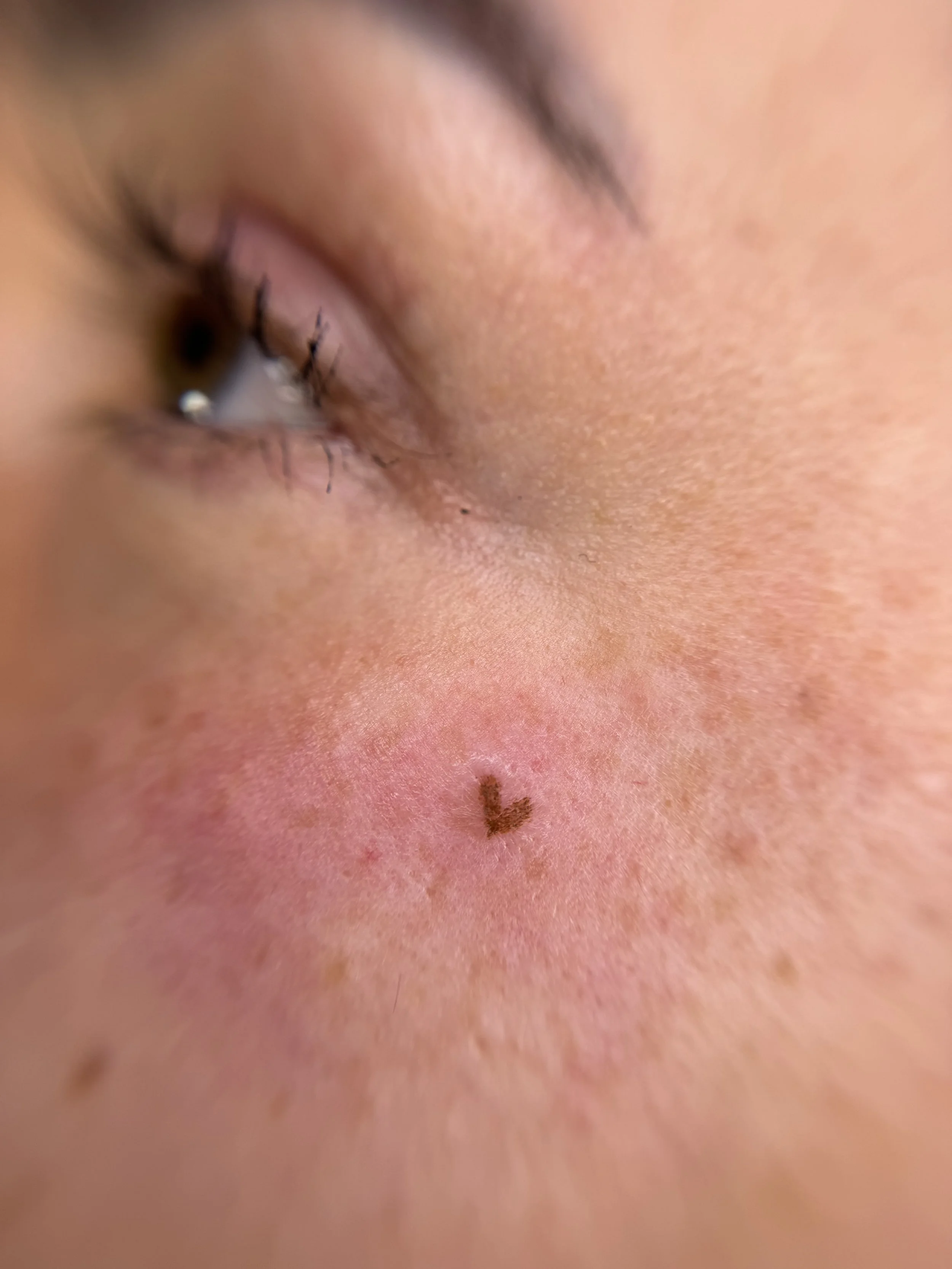 Heart freckles leeds manchester uk