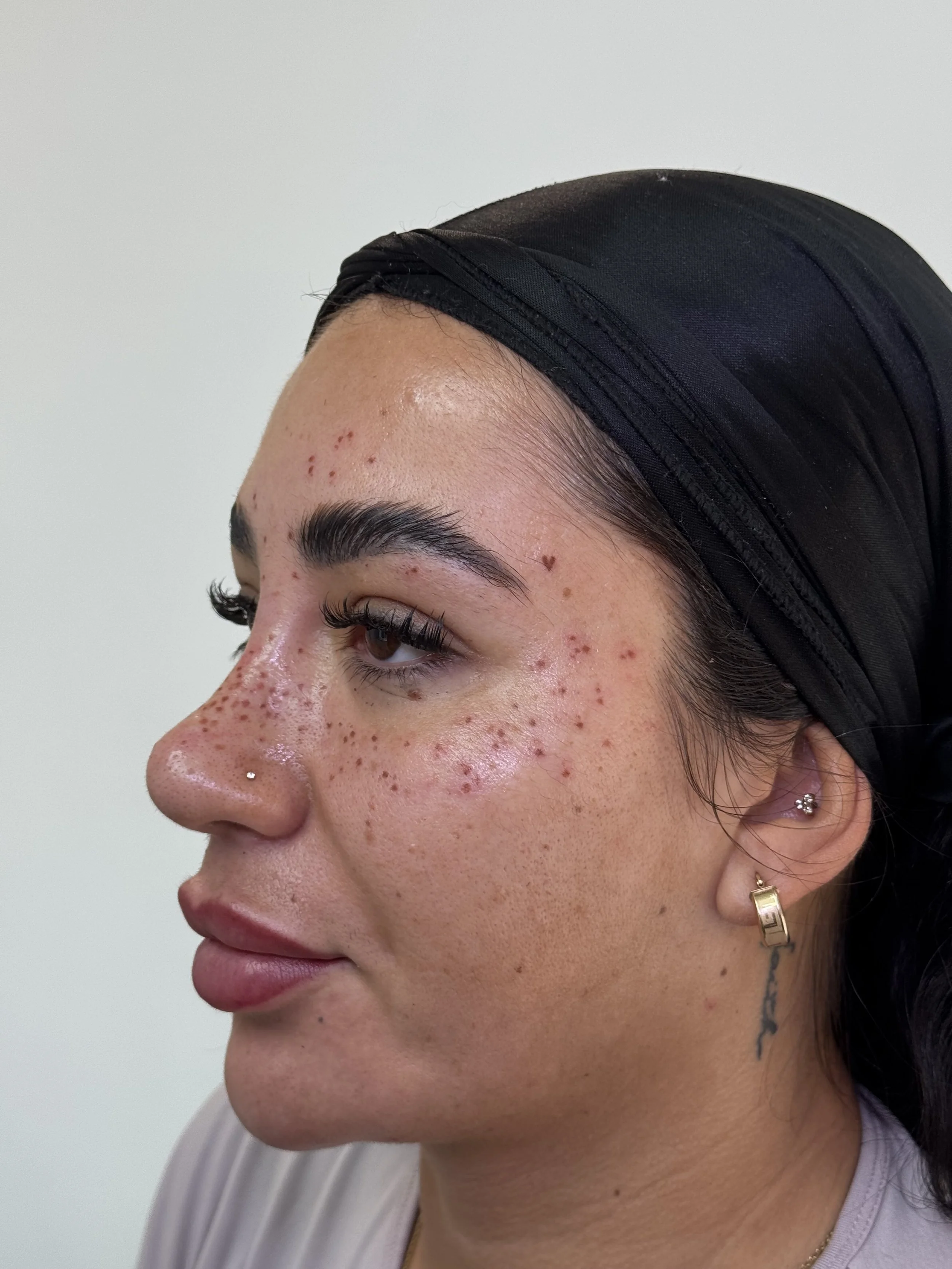 Close-up of a woman's face showing fresh faux freckle pmu tattoos, Leeds