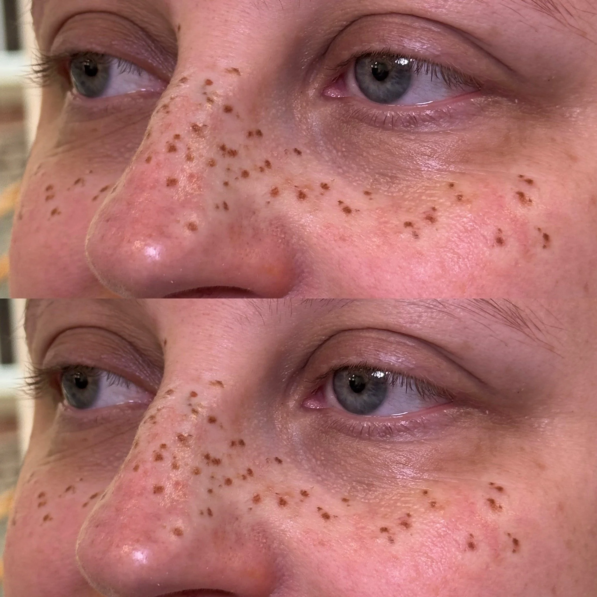 close up after treatment for faux freckle tattoo pmu leeds uk