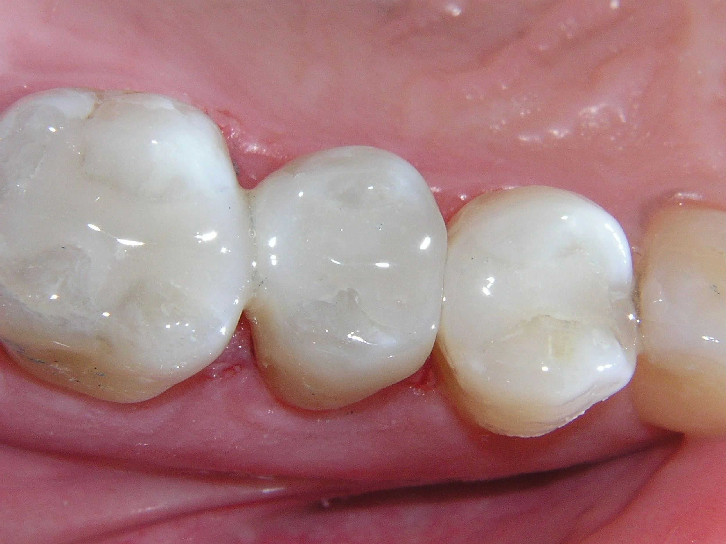 Close-up of several white molar teeth in a person's mouth with pink gums visible in the background.