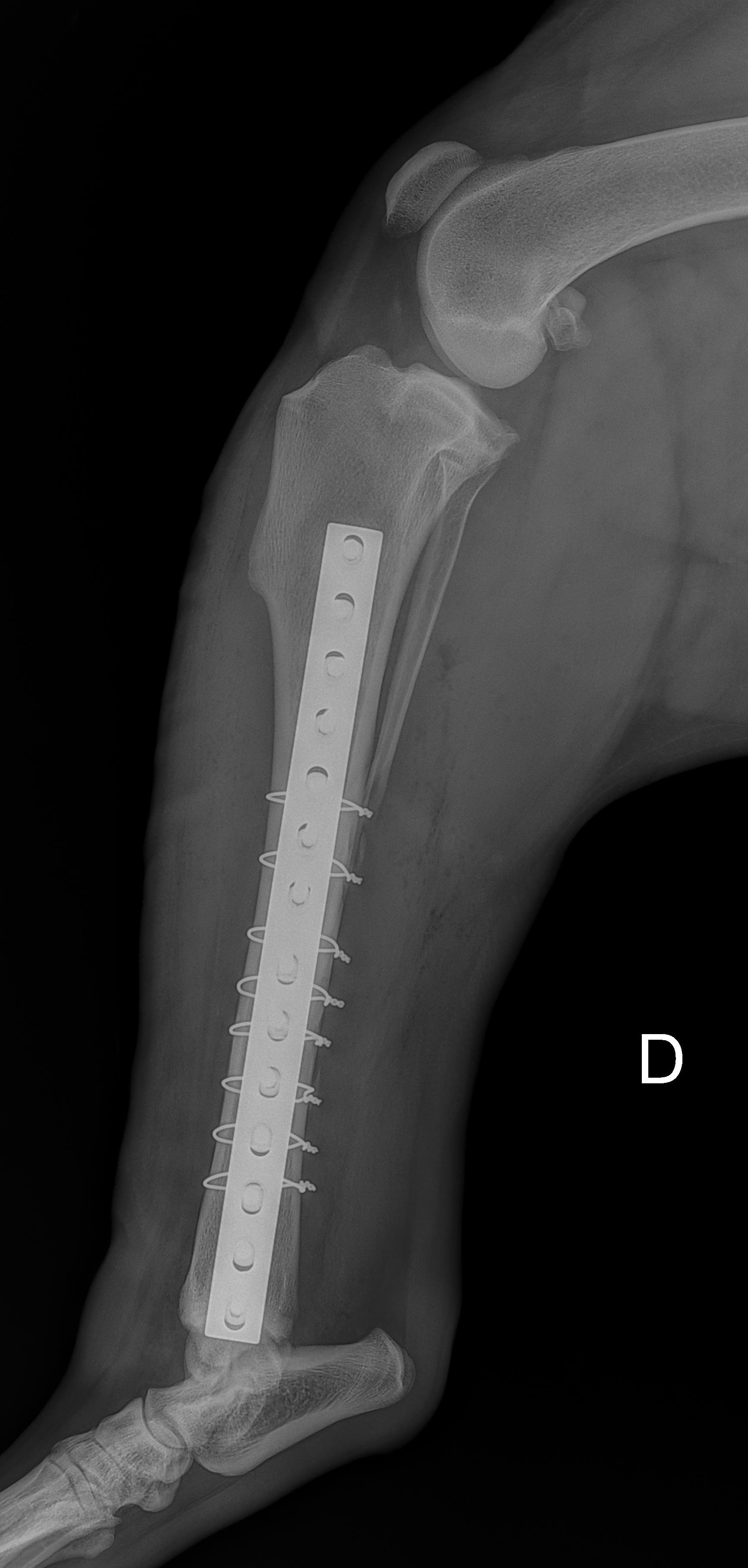 Radiographie d'une jambe présentant une fracture avec une plaque métallique fixant l'os.