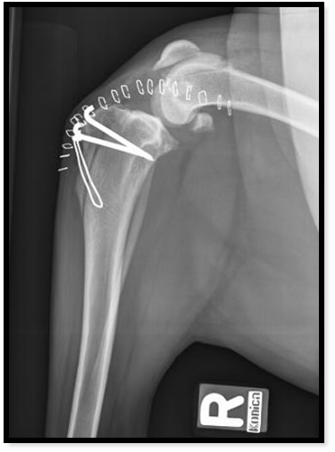 Radiographie du bras montrant une fixation par plaques et vis au niveau de l'épaule et du bras.