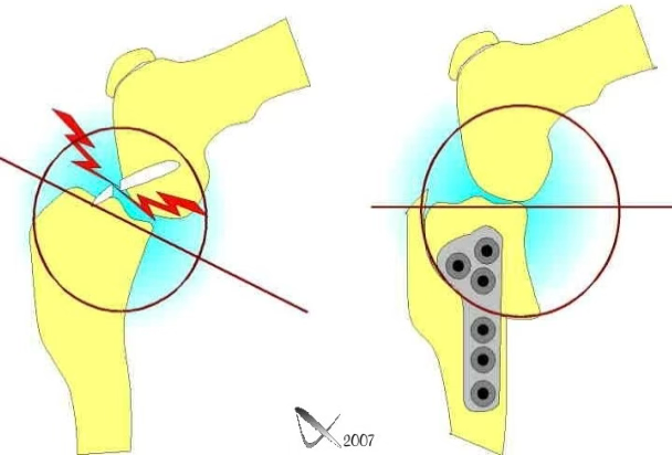 Schéma anatomique illustrant la technique de TPLO lors de déchirure du ligament croisé cranial.