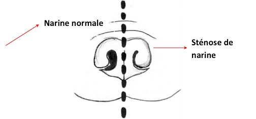Diagramme illustrant une narine normale et une sténose de la narine.
