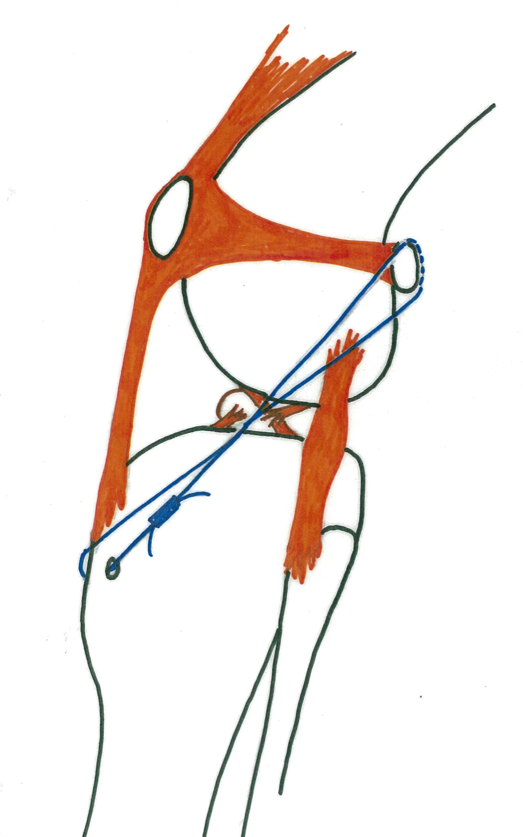 Schéma anatomique illustrant la technique de stabilisation extracapsulaire lors de déchirure du ligament croisé cranial.