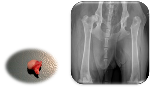 Radiographie du bassin illustrant une chirurgie d'excision arthroplastique de la hanche. Image de la tête et du col fémoraux retirés.