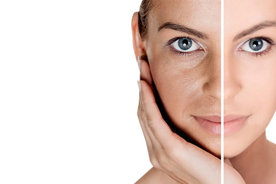Split image of a woman showing one side with oily, acne-prone skin and the other side with clear, smooth skin.