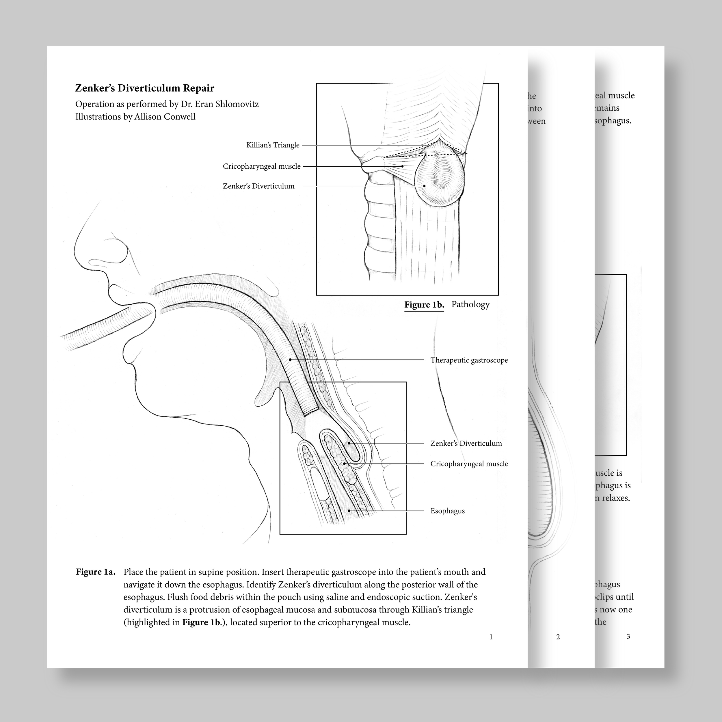 Zenker's Diverticulum Repair Surgical Illustration