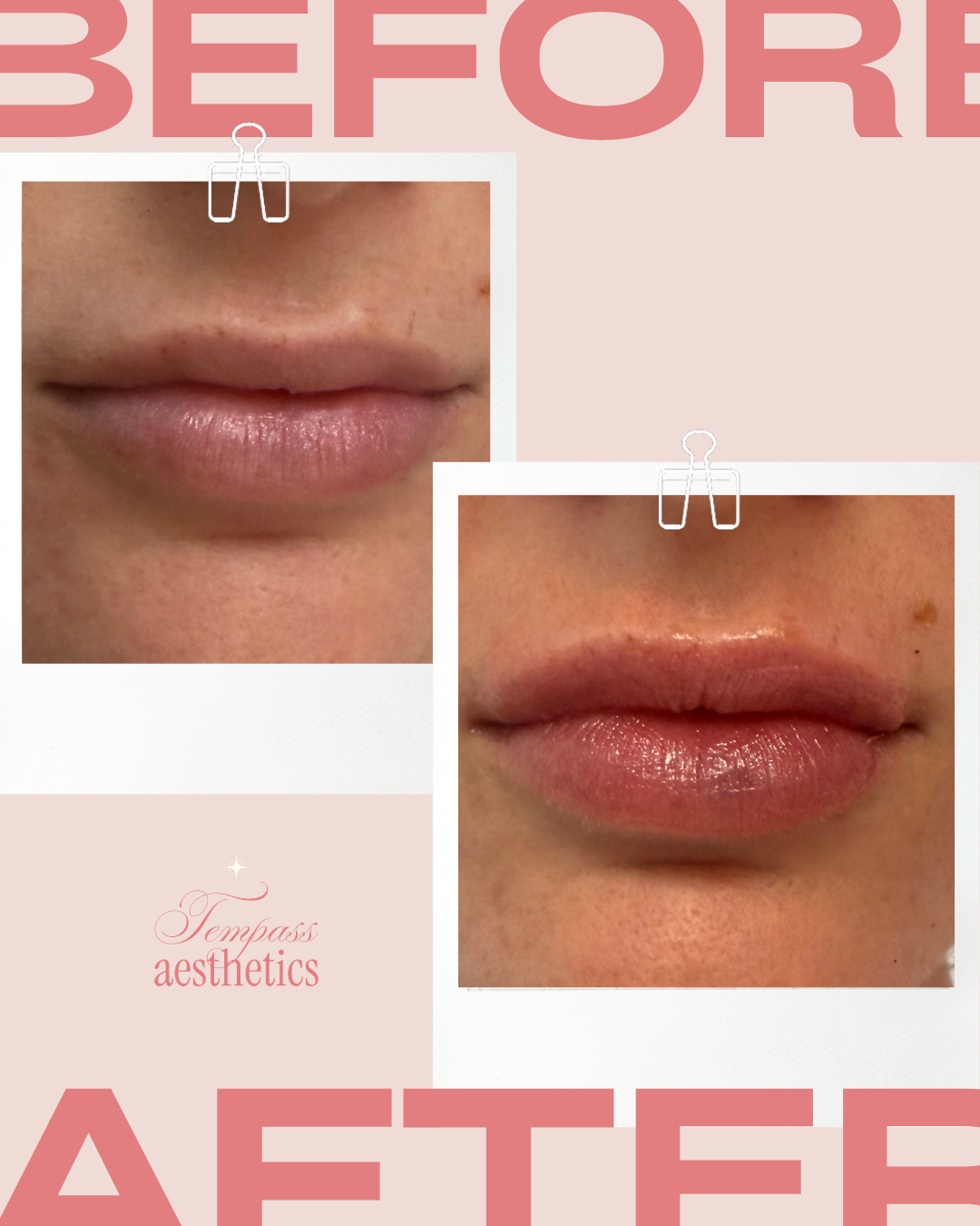 Lip Filler - Before & After 
