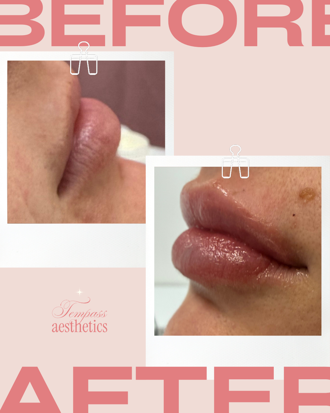 Lip Filler - Before & After 