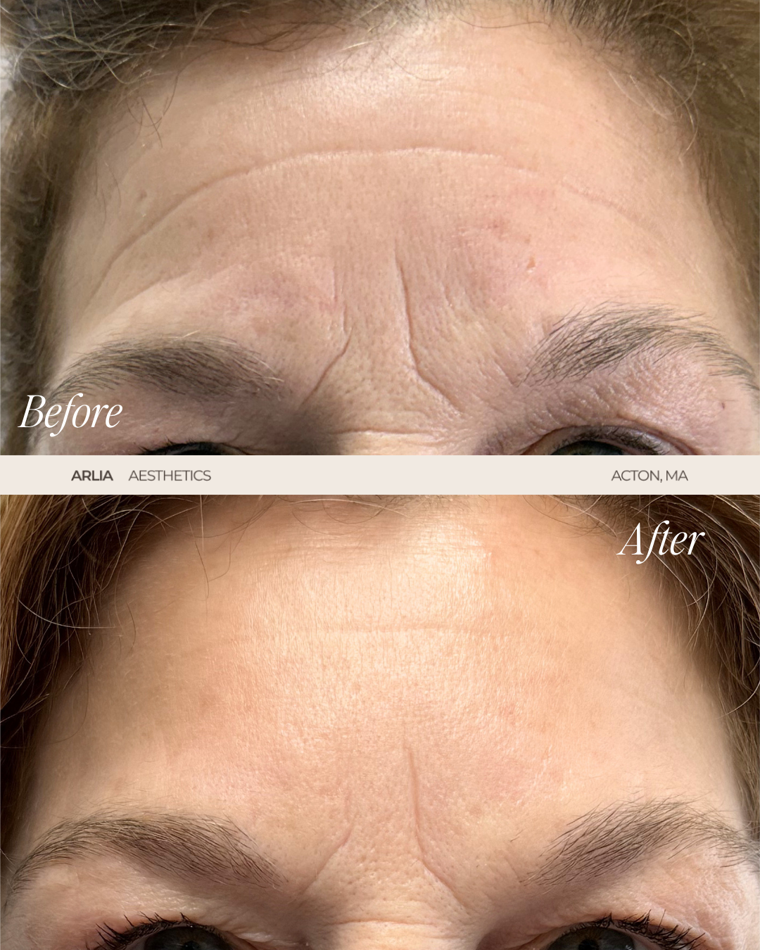 Arlia Aesthetics | Medspa in Acton, MA, 1720 | Botox, Filler, Microneedling(7)