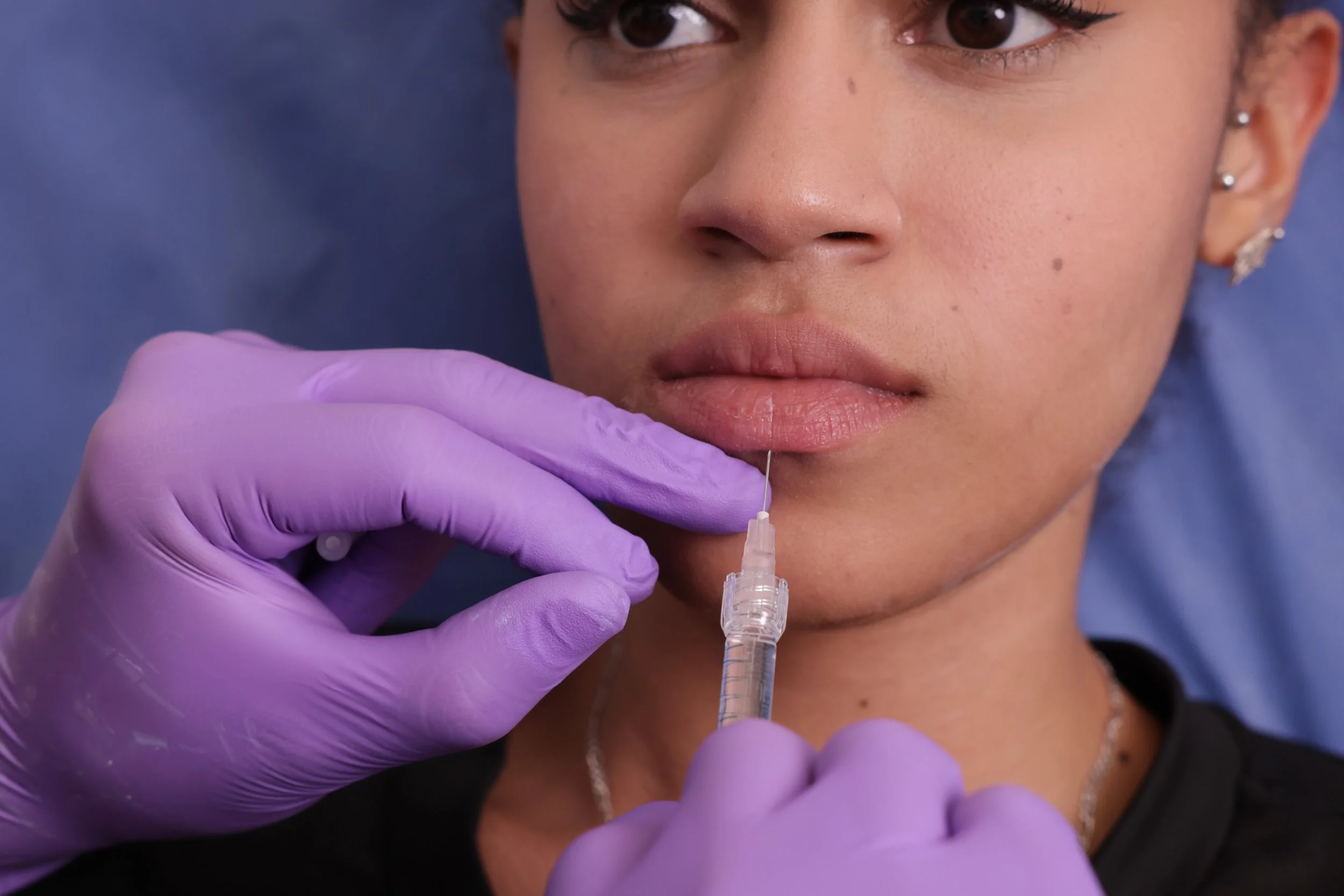 Close-up photograph of a person with dark hair and earrings receiving a medical injection in their face from a healthcare professional wearing purple gloves, with a blue background.