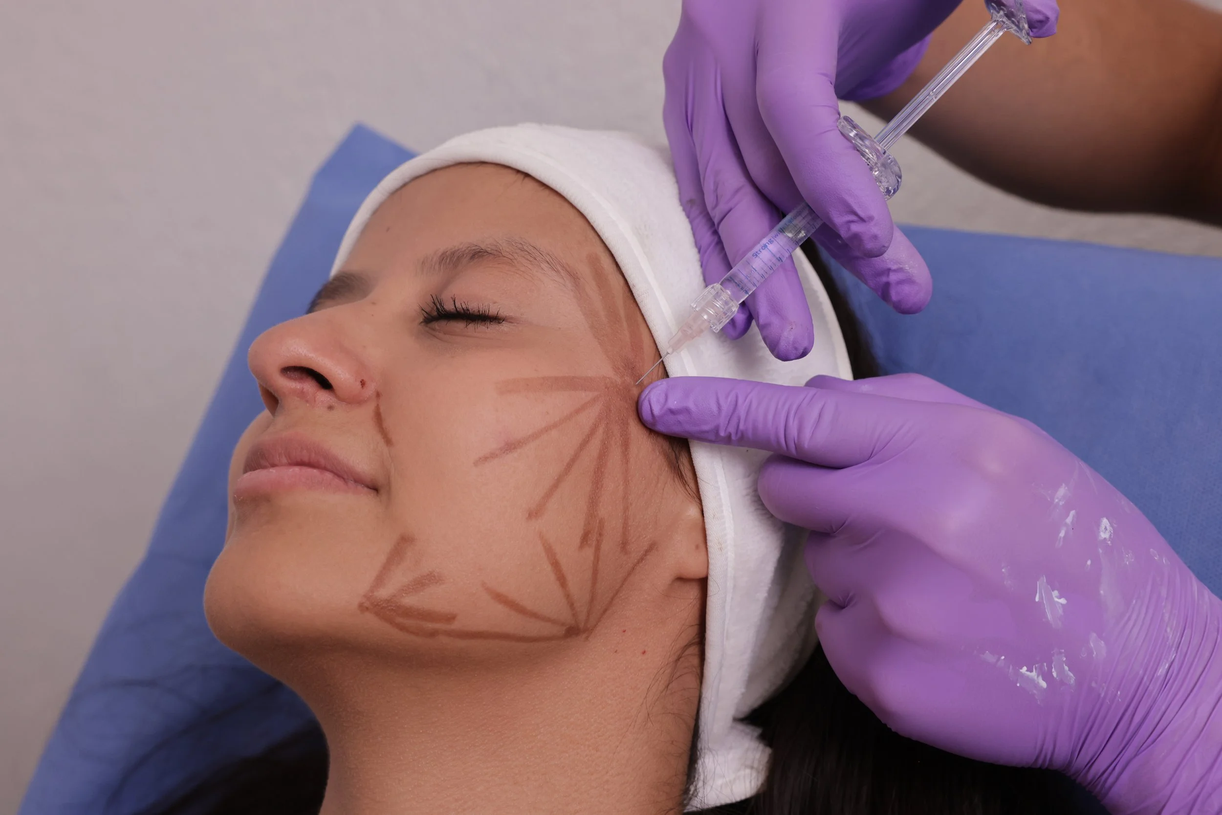 A person receiving a cosmetic injection on their face from a medical professional wearing purple gloves.