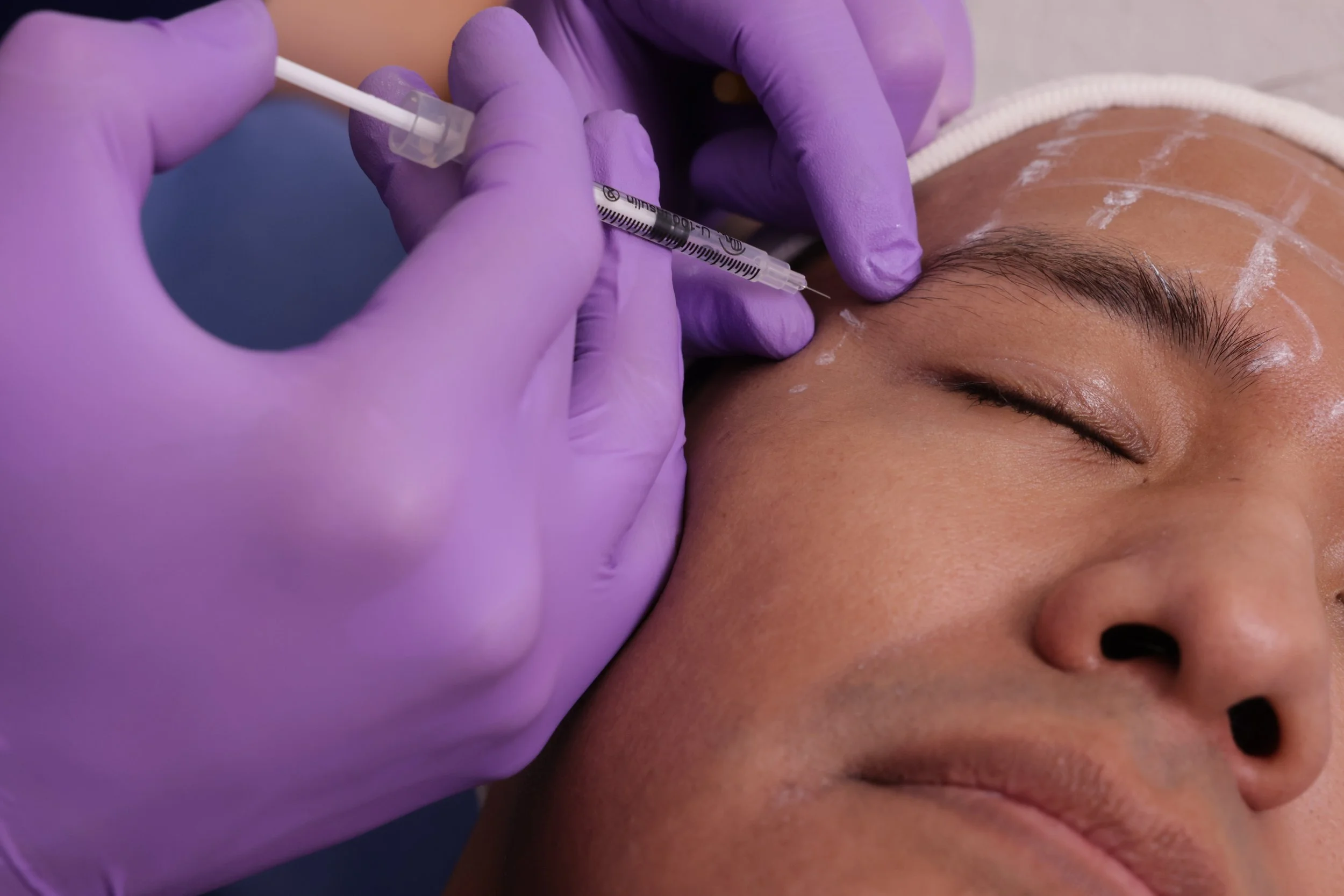 A person receiving an injection in the eyebrow area while wearing purple gloves.
