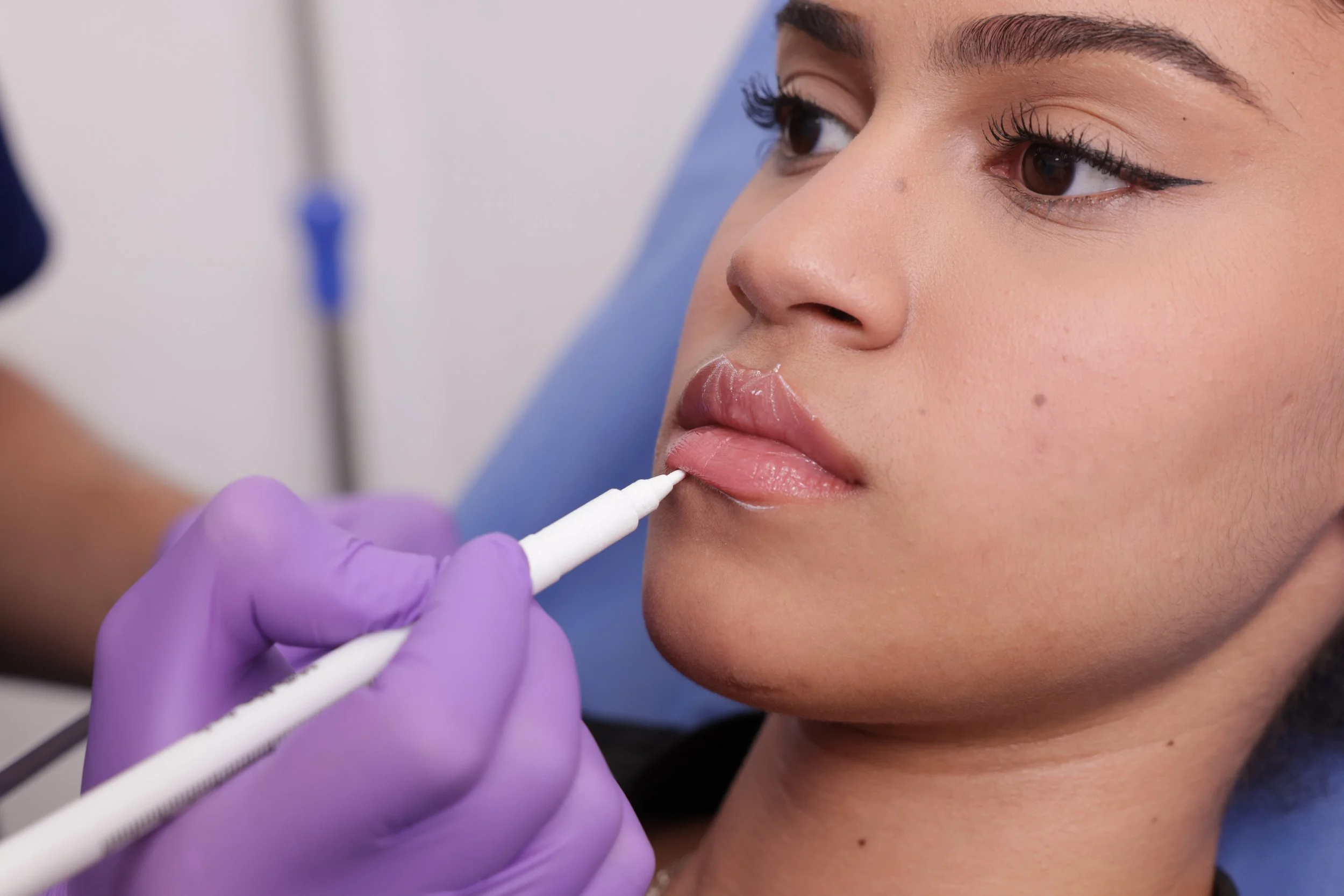 A woman is receiving a cosmetic injection near her lips from a healthcare professional wearing purple gloves.