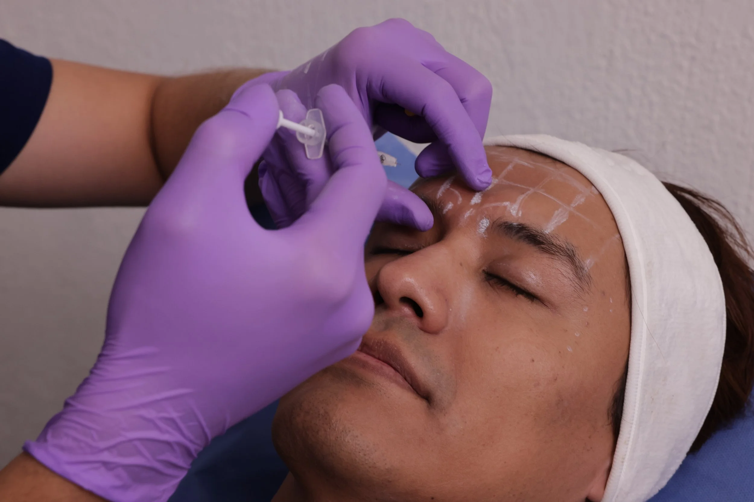 A person receiving a cosmetic or medical treatment on their face, with a healthcare worker wearing purple gloves administering an injection or similar procedure.