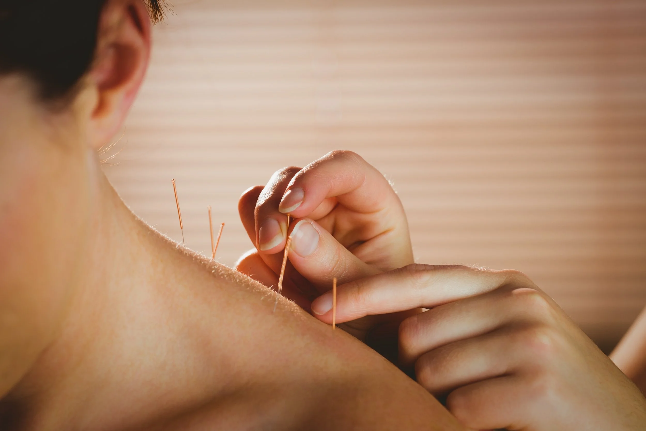 acupuncture for neck pain back pain shoulders headache migraine