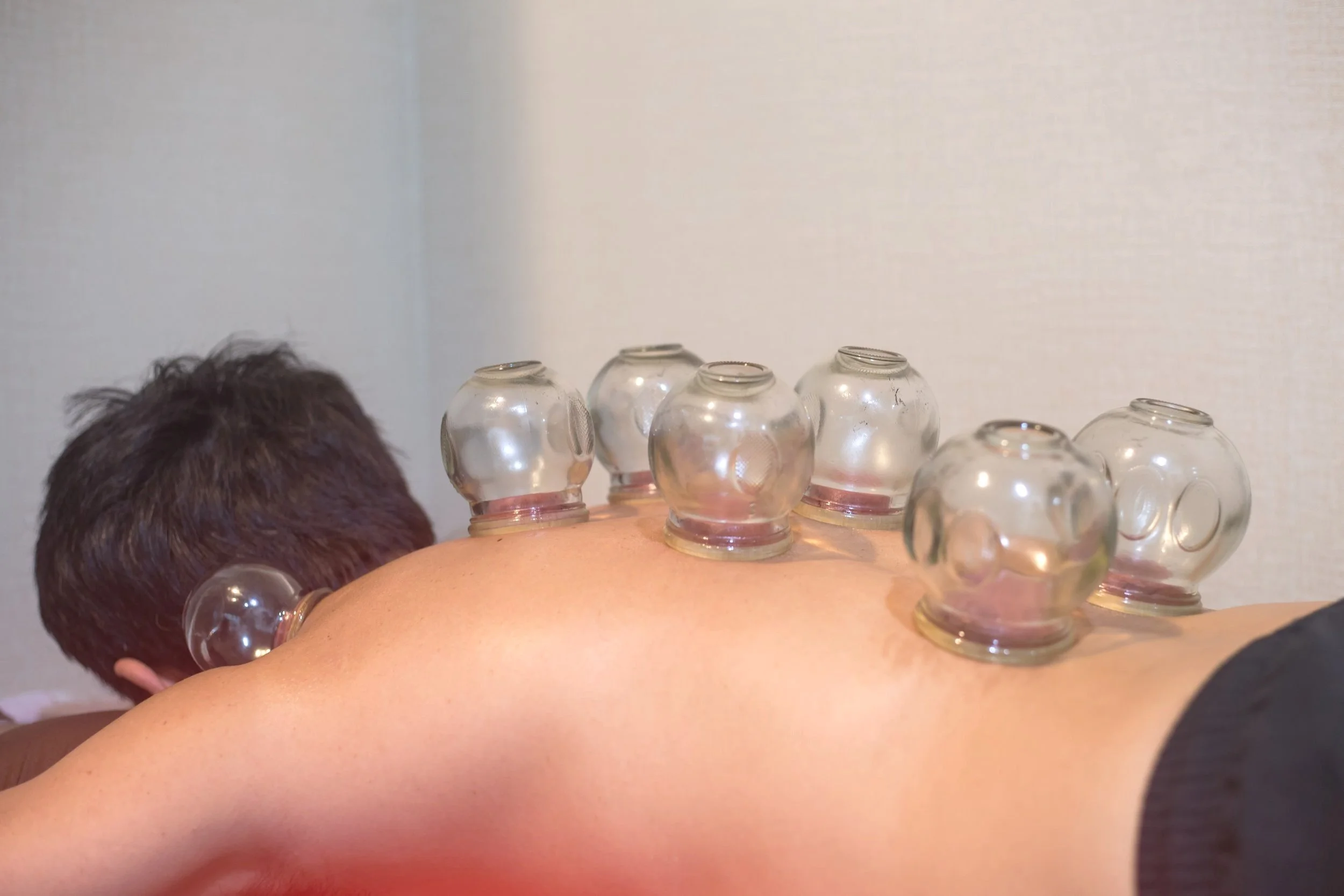 cupping stimulates healing blood flow heaviness reduce back pain blood circulation