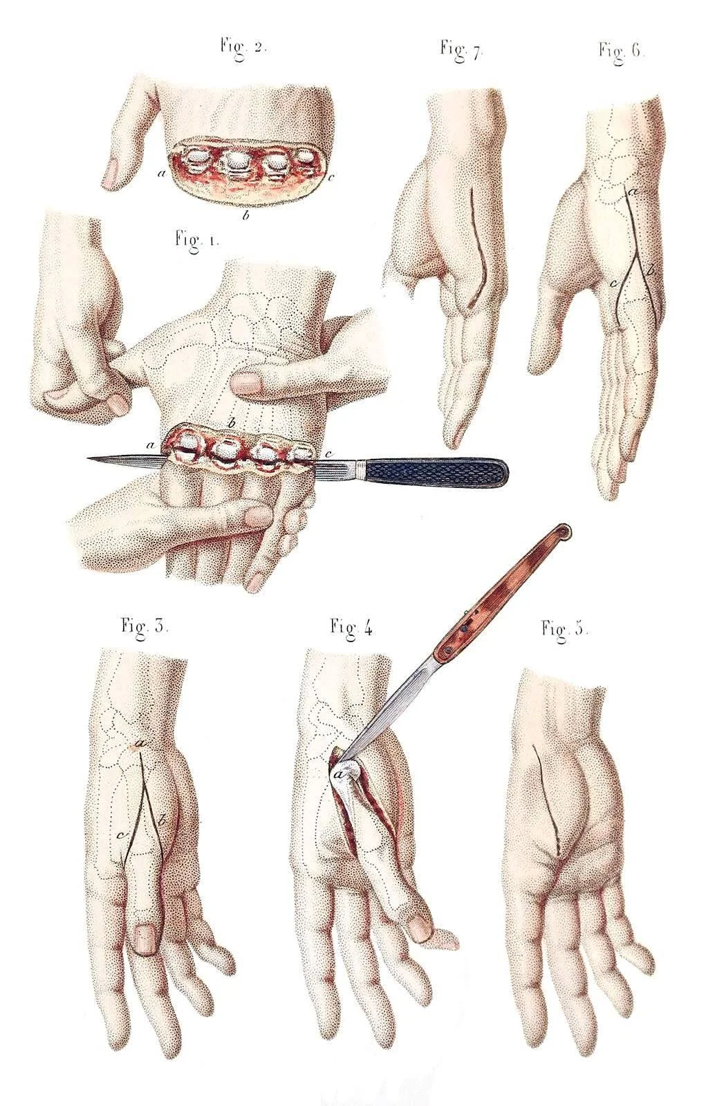 Désarticulation des quatre derniers doigts et des métacarpes - Jean-Baptiste Léveillé, 1848  
