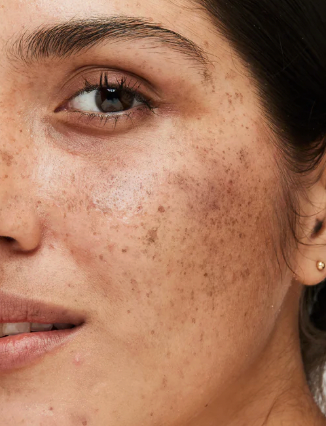 Melasma
