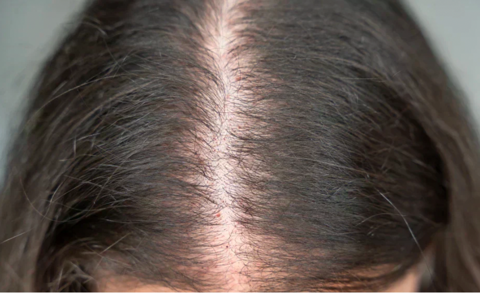 Hair loss