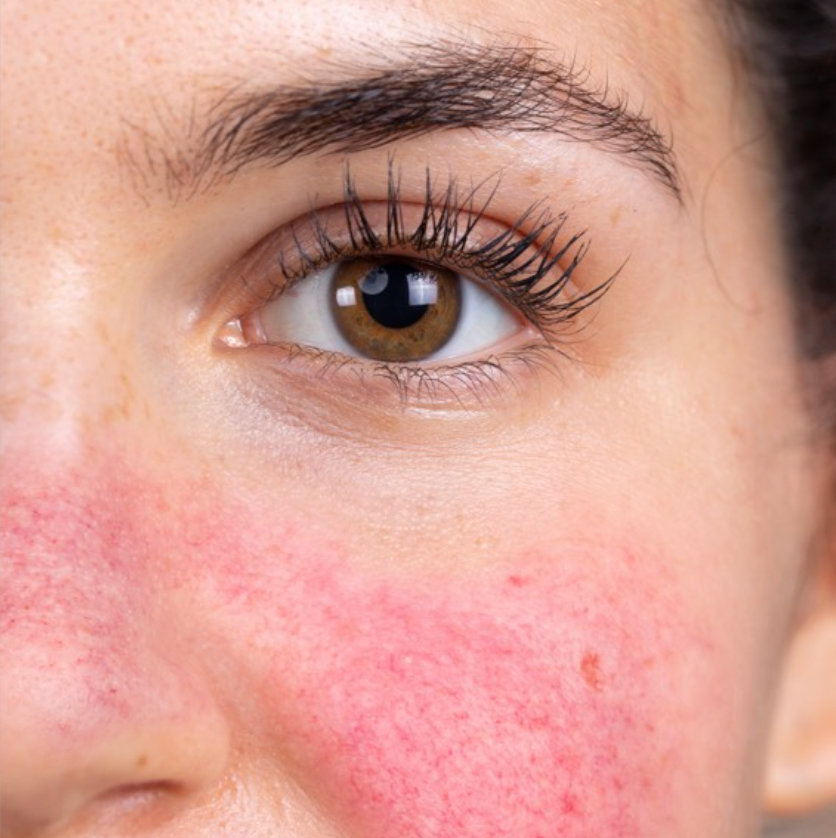 Rosacea, facial redness, telangiectasias
