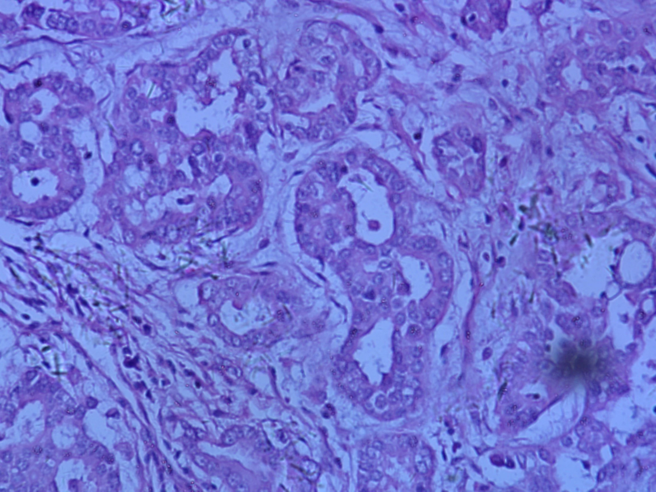 The high variability of prostate cancer Treatment