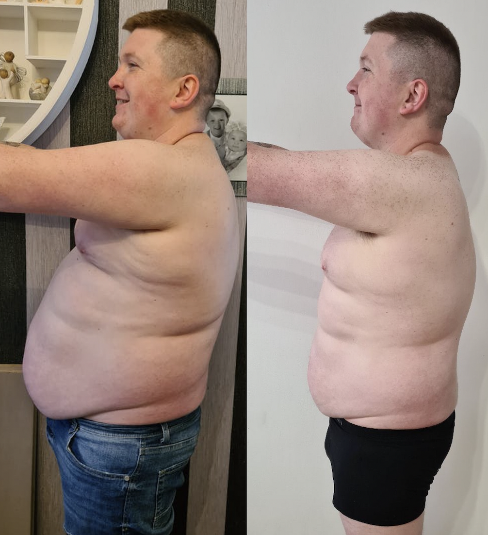 Side-by-side comparison of a man before and after weight loss, showing a reduction in body fat and a healthier physique.