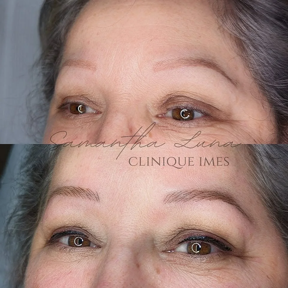 A before-and-after comparison of a woman's face showing the results of cosmetic treatment. In the 'before' image, her skin shows wrinkles and sagging around the eyes. In the 'after' image, her skin appears smoother, tighter, and more youthful around the eyes.