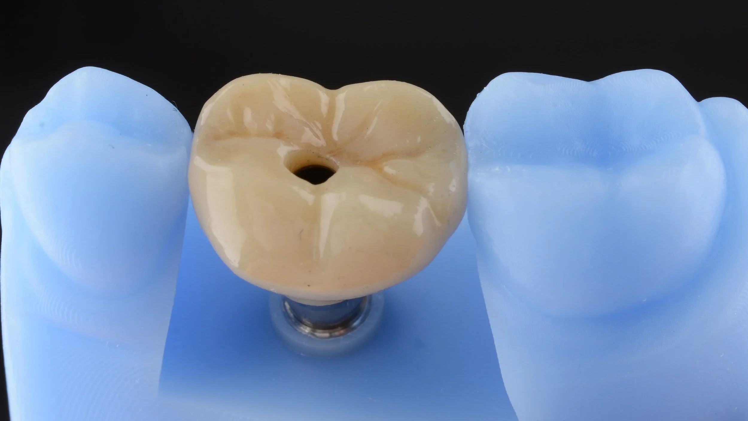Implant Restorations