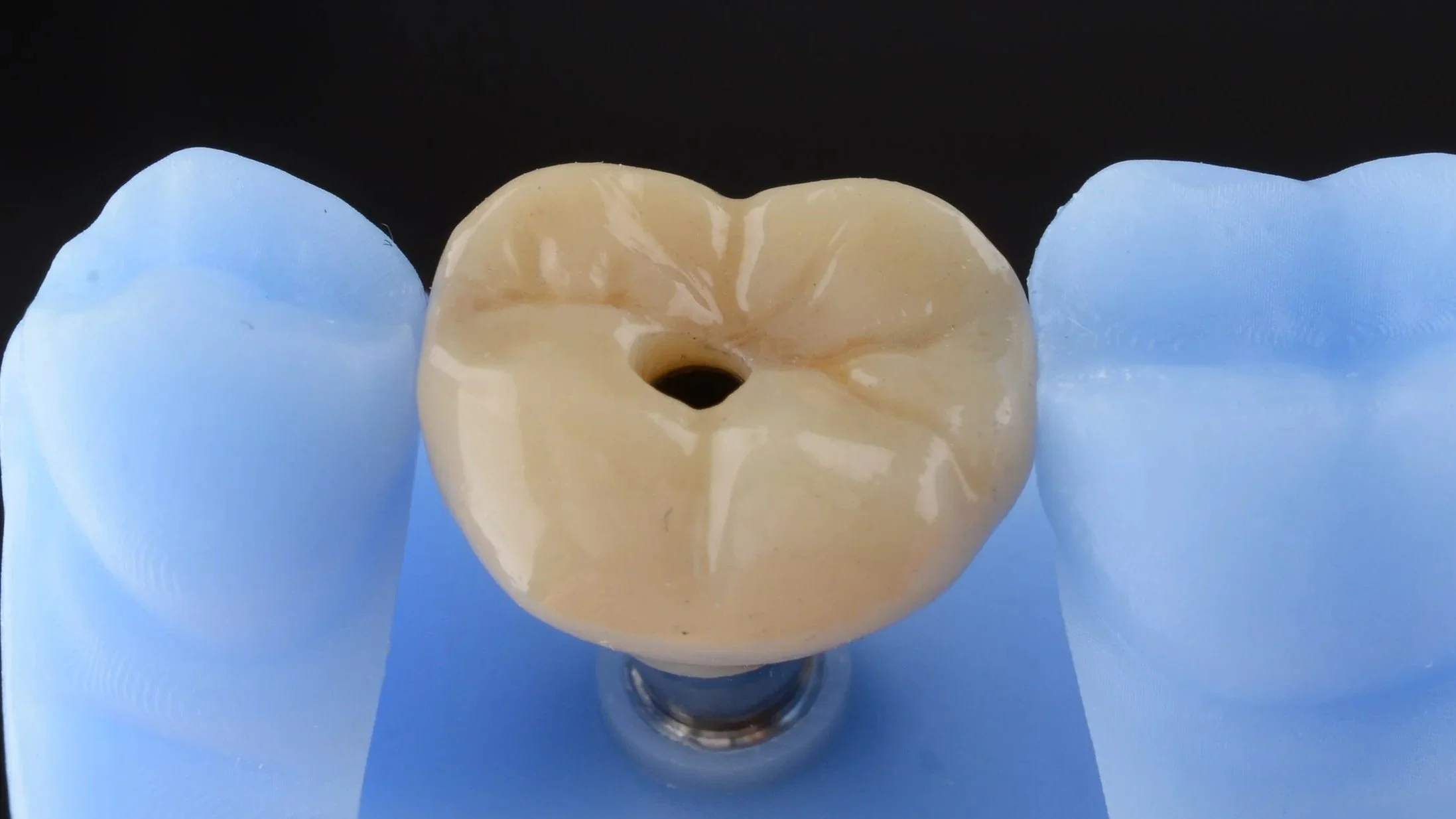 Implant Crowns