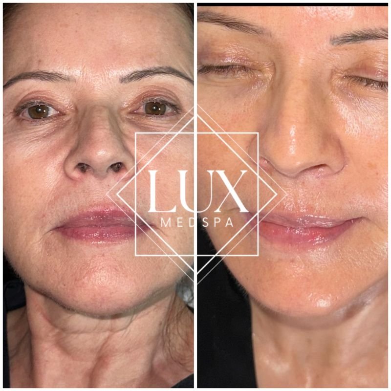 Before-and-after results from a Hydrafacial treatment at Lux MedSpa Brickell — showing visibly smoother texture, improved hydration, and a brighter, more even complexion. This is part of our monthly facial protocol designed by Founder Alan Araujo for