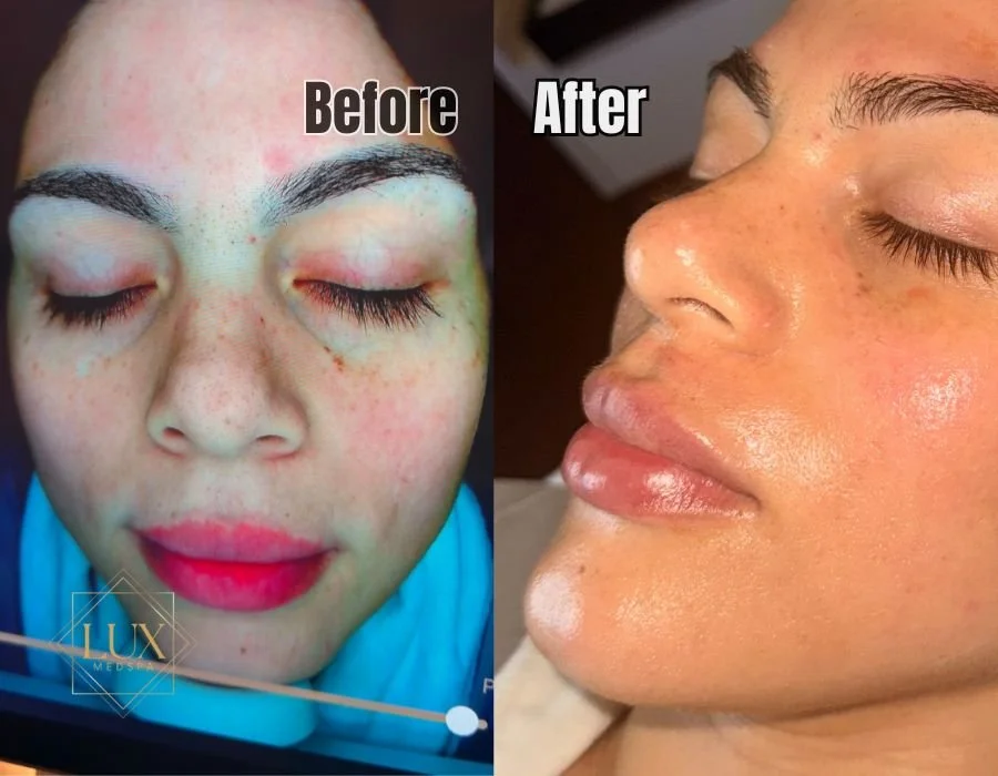 Before-and-after results from our Microneedling with EMS and Light Therapy treatment at Lux MedSpa Brickell — showing smoother texture, refined pores, and a brighter, more even complexion. This advanced protocol activates collagen, enhances circulati