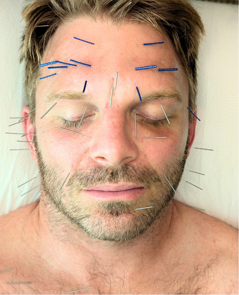 Why Choose Facial Rejuvenation Acupuncture Over Botox (2).png