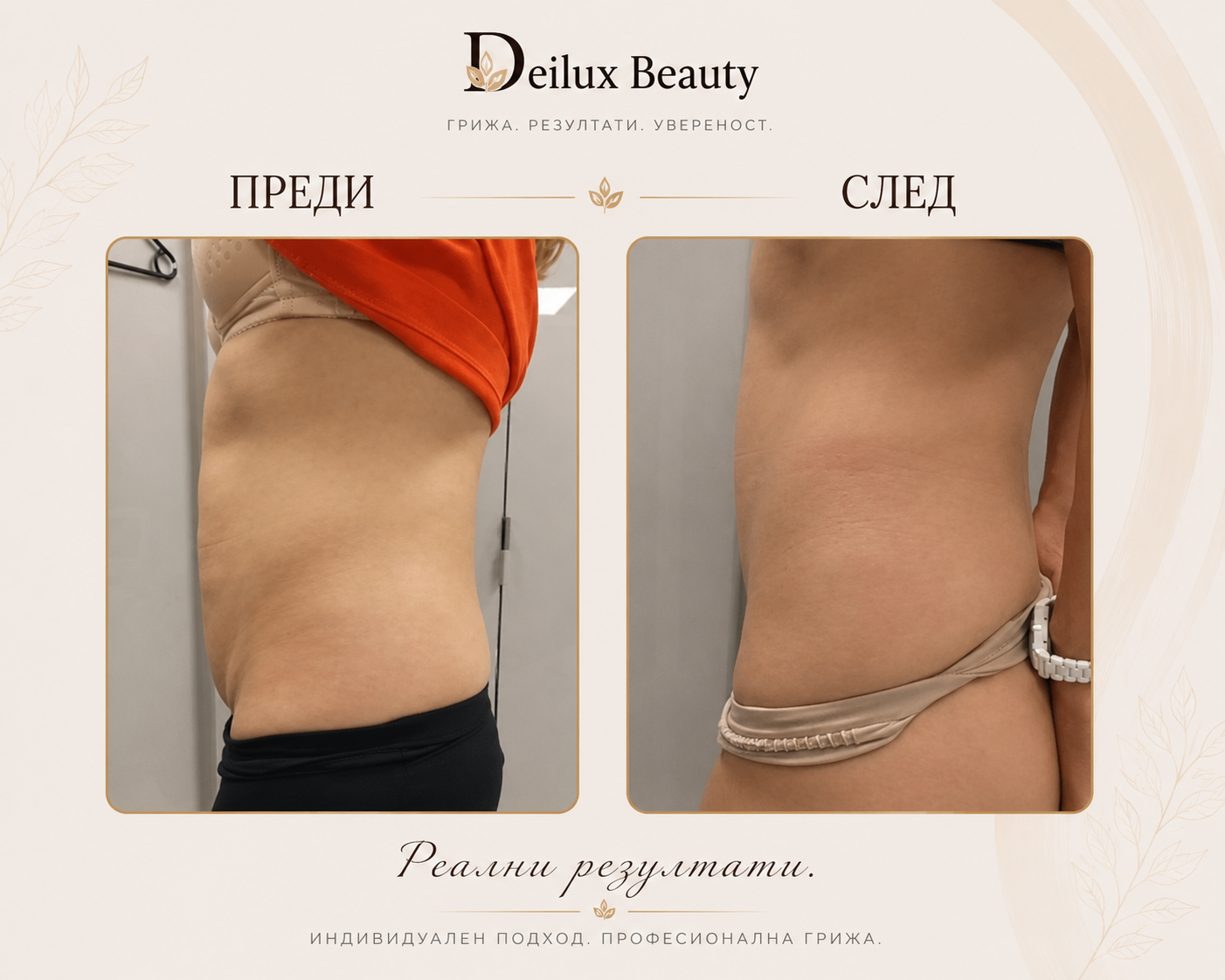 Infra Lymph Detox и Антицелулитна терапия преди и след в Deilux Beauty София