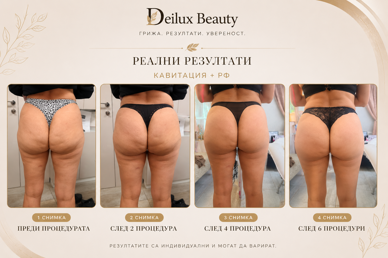 Терапия кавитация и RF преди и след в Deilux Beauty София