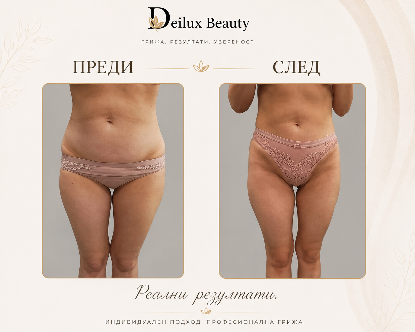 Антицелулитна терапия преди и след в Deilux Beauty София