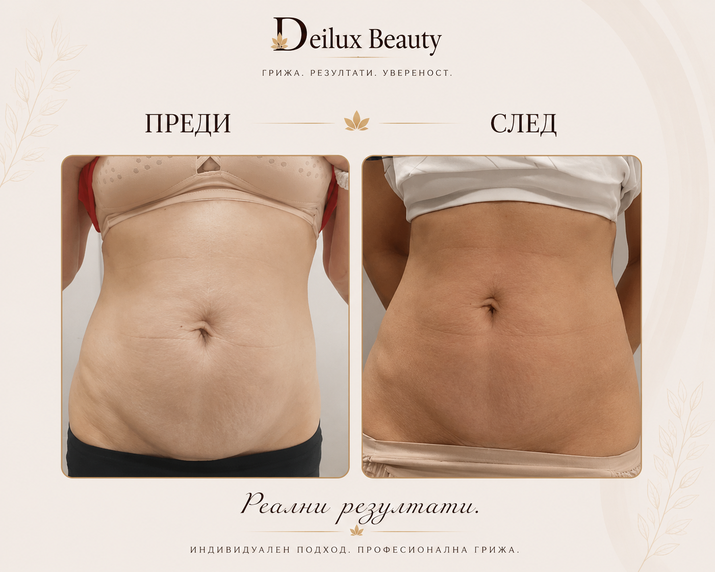 Радиочестота терапия преди и след в Deilux Beauty София