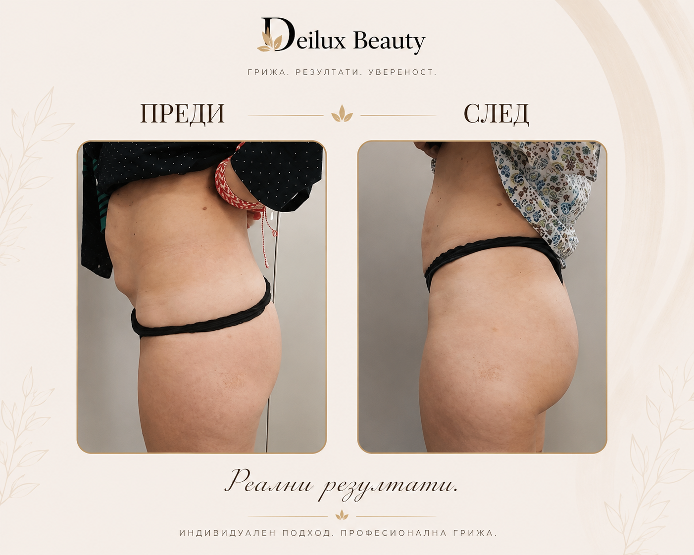 Антицелулитна терапия преди и след в Deilux Beauty София