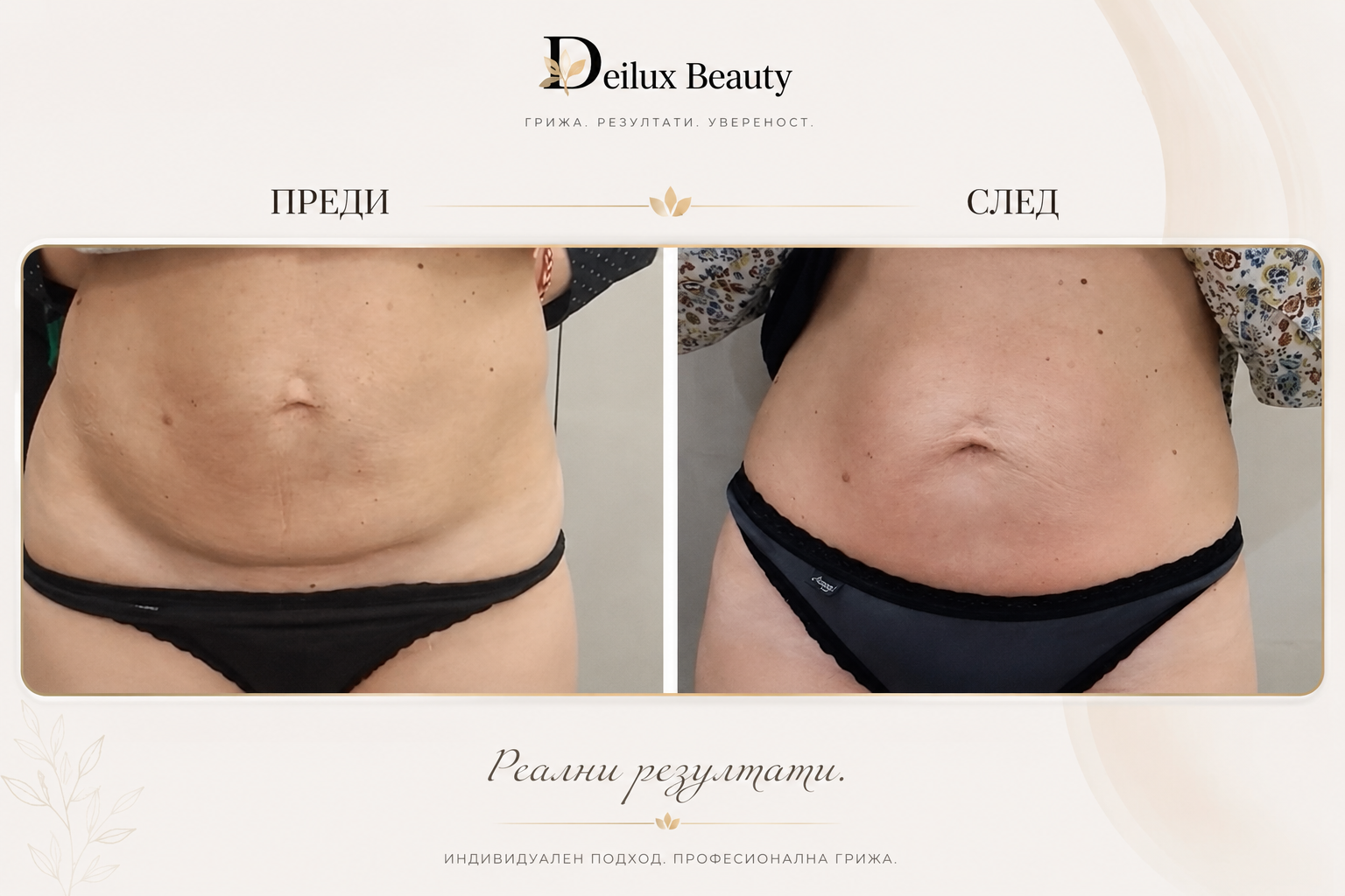 Антицелулитна терапия преди и след в Deilux Beauty София