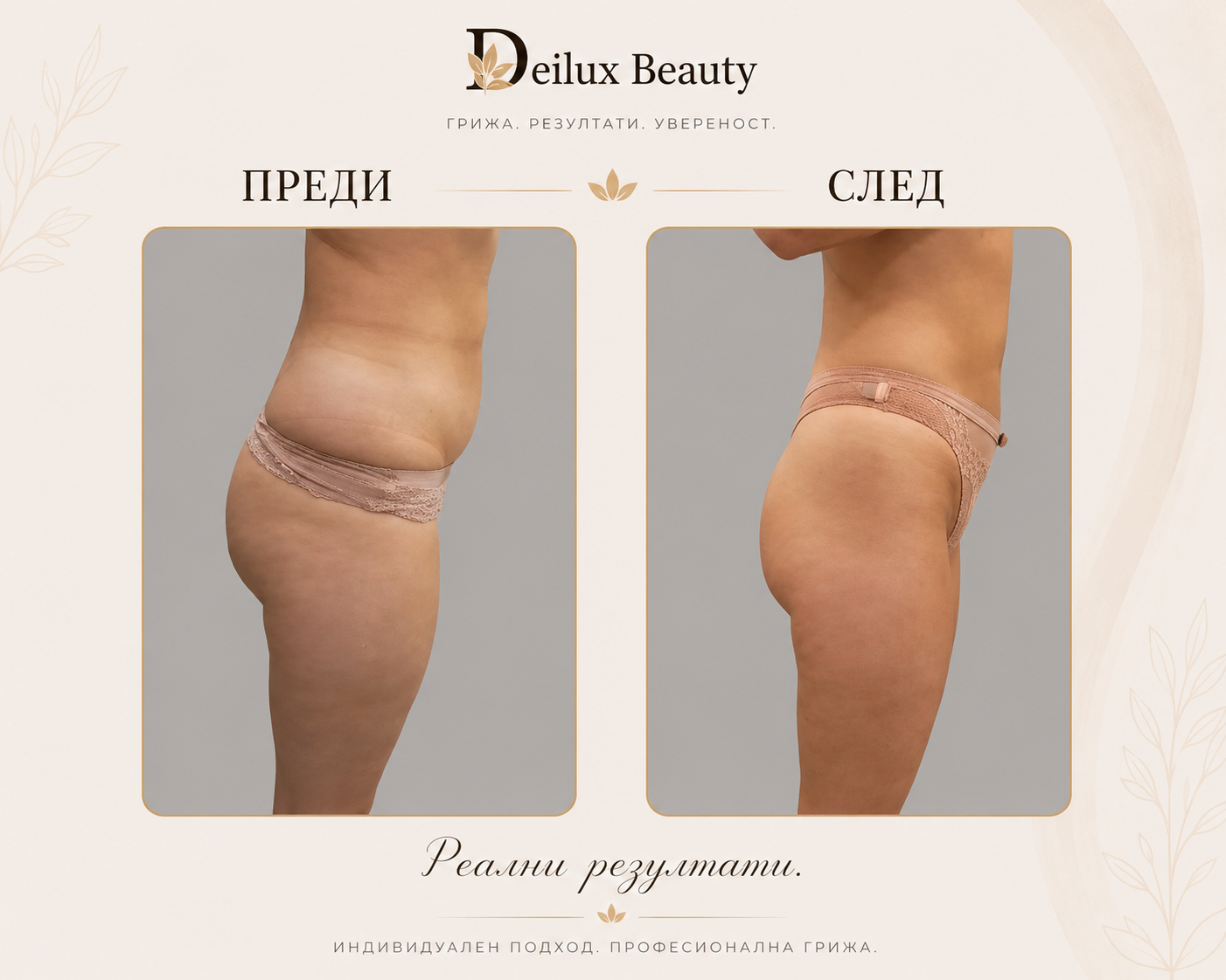 Антицелулитна терапия преди и след в Deilux Beauty София
