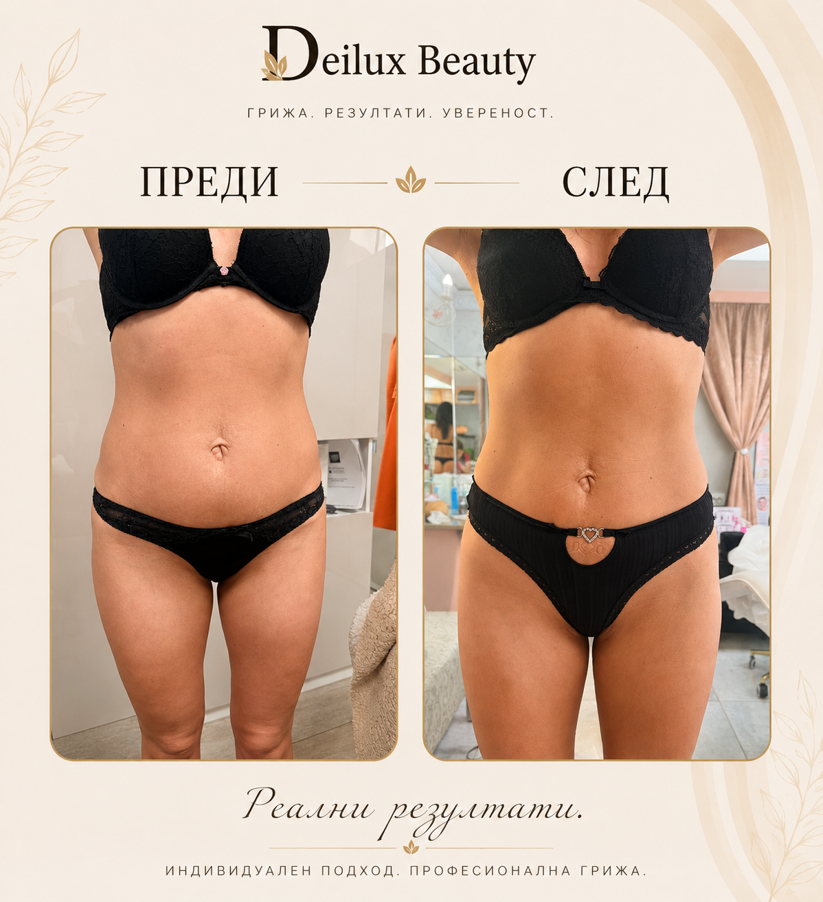 Терапия липолазер и вибромсаж преди и след в Deilux Beauty София