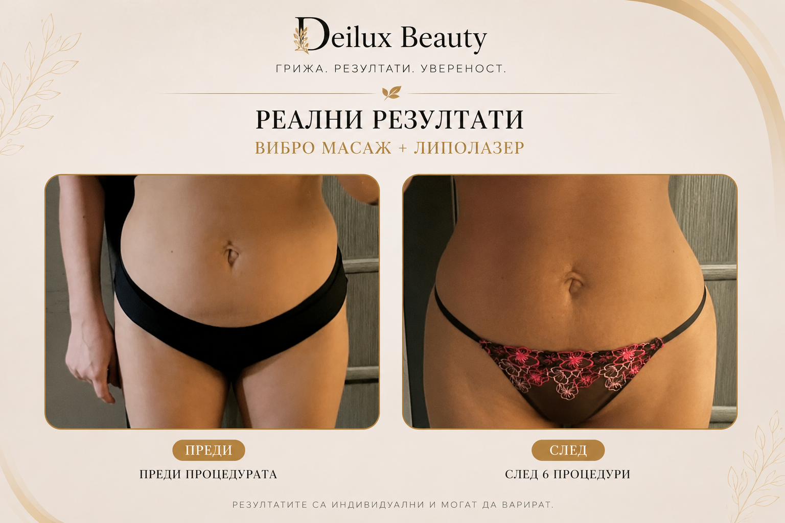 Антицелулитна терапия преди и след в Deilux Beauty София