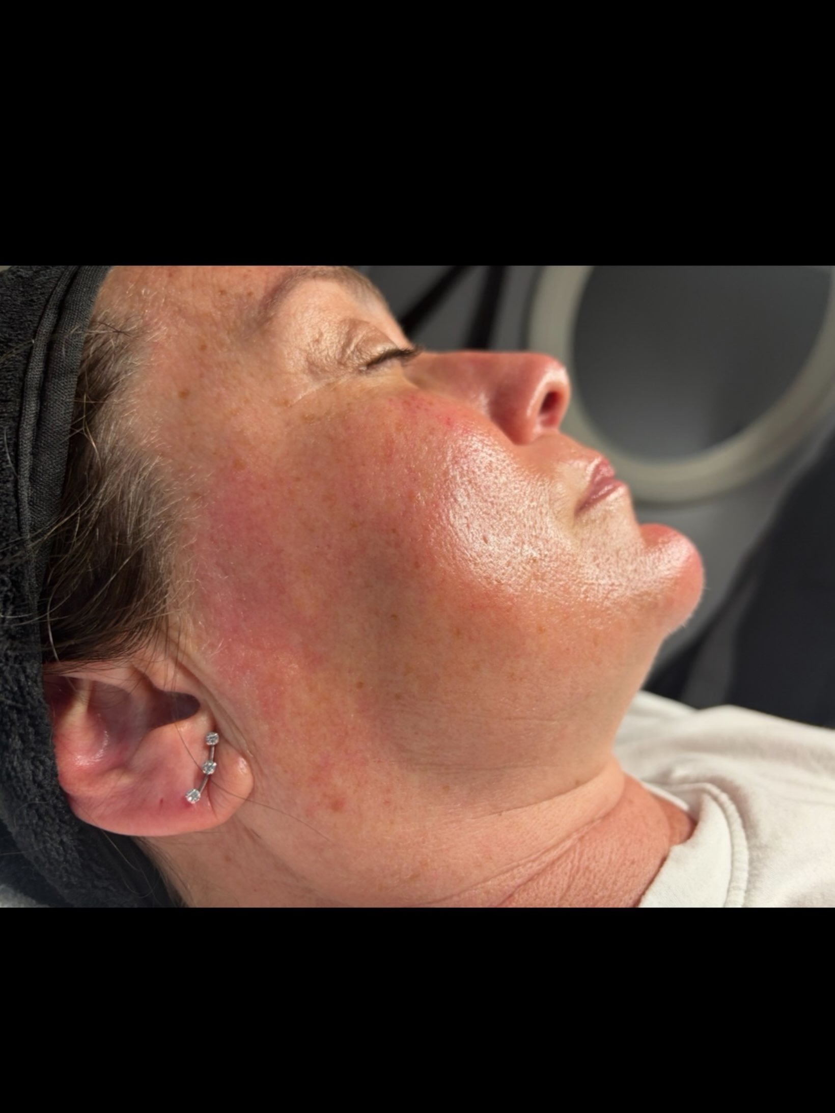 Glowing after just one Hydrafacial treatment!✨

Hydrafacial is a great treatment year-round, whether you&rsquo;re preparing for a special occasion, looking to treat yourself to some self-care, or hoping to address specific skin concerns such as dehyd
