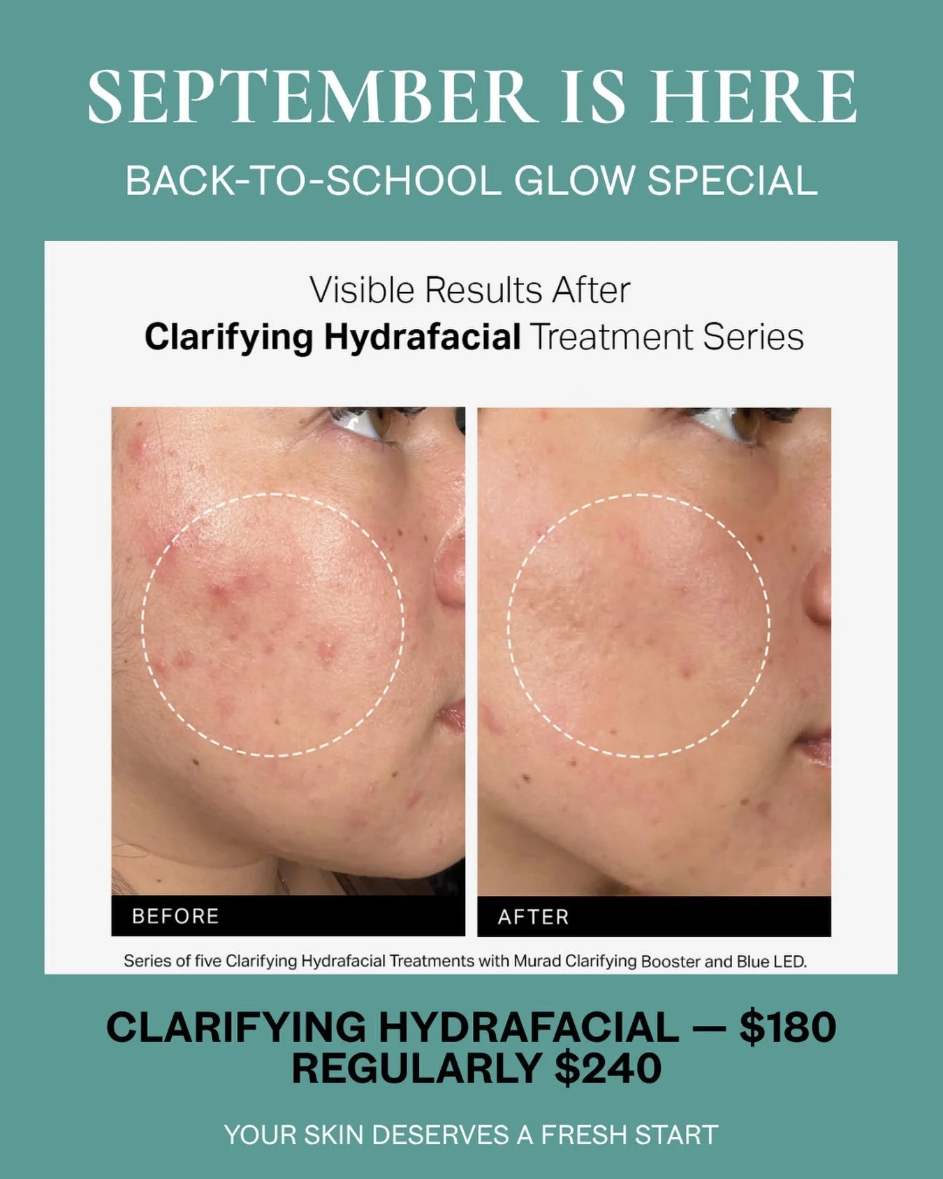 SEPTEMBER IS HERE!

Don&rsquo;t forget about my Back-to-School Glow Special! 

For September only, enjoy a Clarifying Hydrafacial for $180 &mdash; regularly $240!

This treatment is especially great for acne-prone, oily, congested, and textured skin,