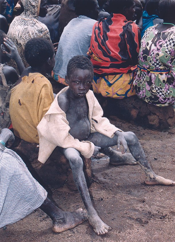 A young boy with visibly thin body and dark skin, sitting on the ground with his legs outstretched, wearing a light-colored jacket open to reveal his skeletal frame. He is surrounded by other children and adults in a rural setting.