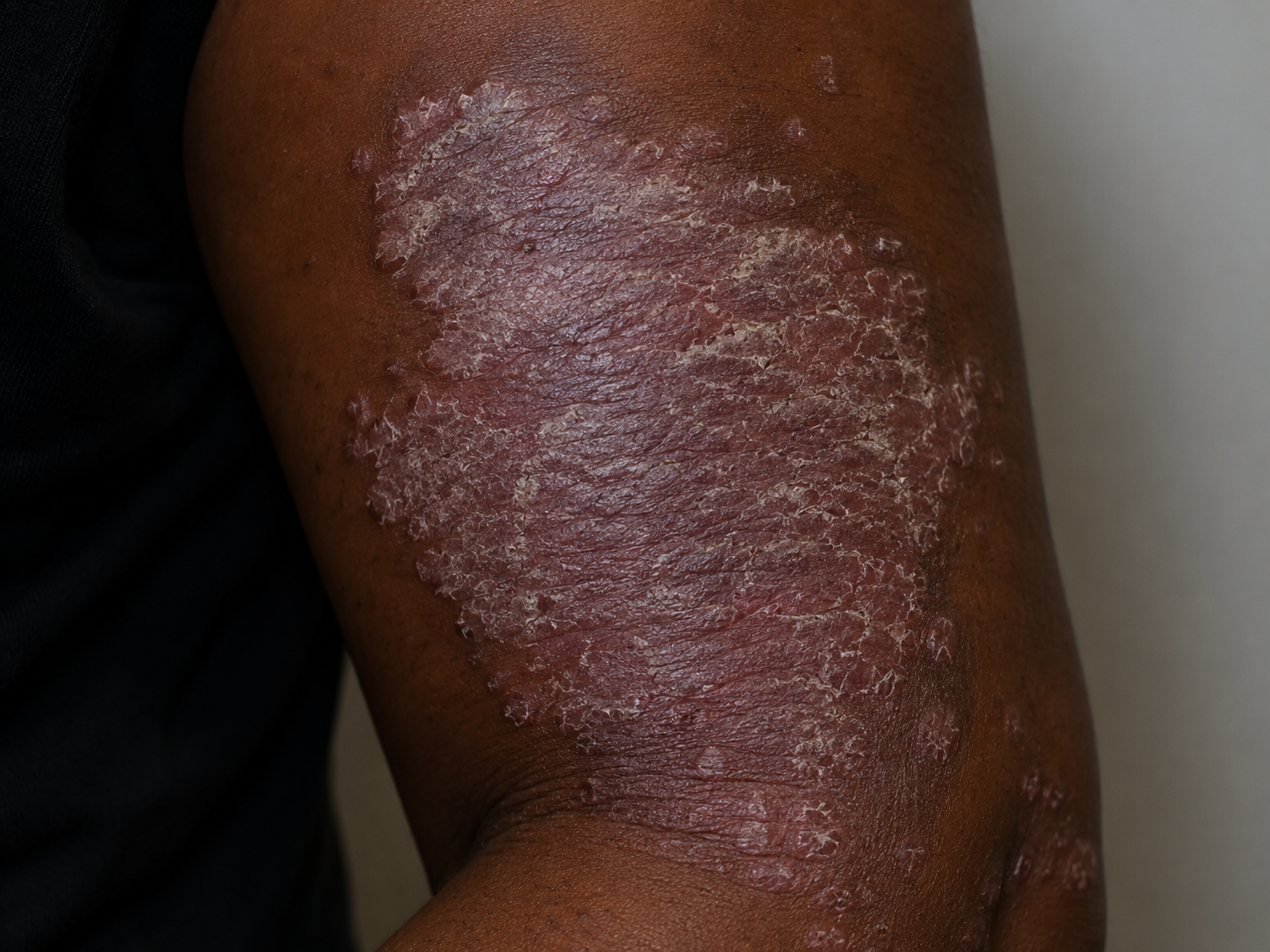 Psoriasis