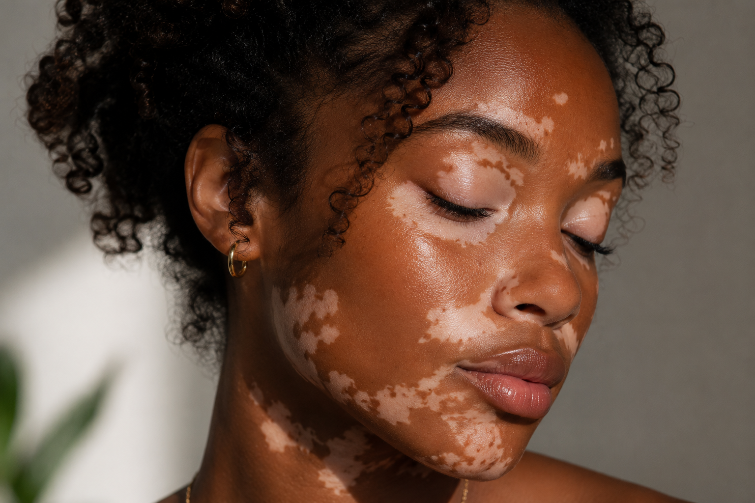 Vitiligo