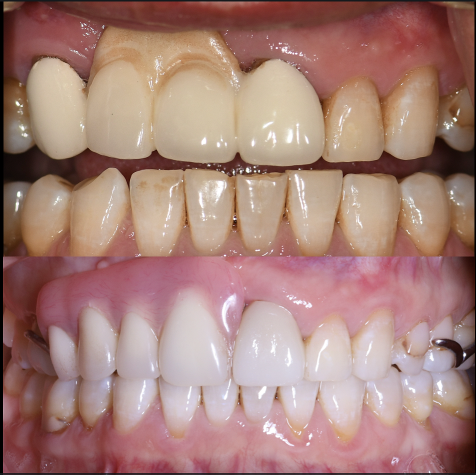 Close-up comparison of teeth before and after dental restoration, showing improved appearance, alignment and cleansability.