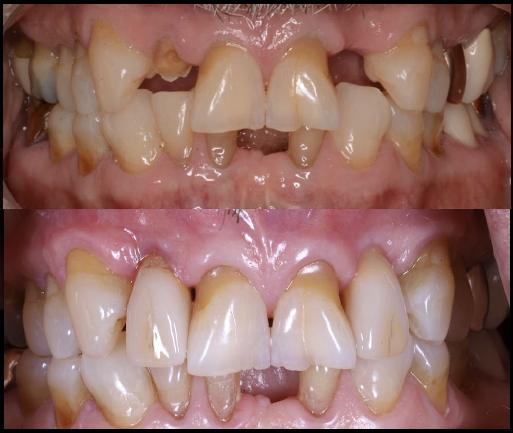 Close-up images of a person's teeth and gums, showing significant dental decay, missing teeth, and plaque buildup in the top image, and improved dental condition with cleaner, healthier teeth and gums as result of complex restoration the bottom image
